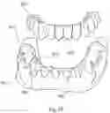 Fig. 16 - Common Placement Support for Artificial Teeth