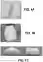 Fig. 02 - METHOD FOR ELIMINATION OF SPACE THROUGH TISSUE APPROXIMATION