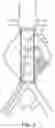 Fig. 11 - DEVICES AND METHODS FOR TREATMENT OF VASCULAR ANEURYSMS