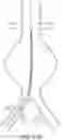Fig. 24 - DEVICES AND METHODS FOR TREATMENT OF VASCULAR ANEURYSMS