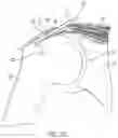 Fig. 07 - Implantable articles for attaching tendons and/or ligaments to bone and/or cartilage, assemblies thereof, and methods of use thereof