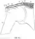 Fig. 13 - Implantable articles for attaching tendons and/or ligaments to bone and/or cartilage, assemblies thereof, and methods of use thereof