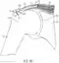 Fig. 15 - Implantable articles for attaching tendons and/or ligaments to bone and/or cartilage, assemblies thereof, and methods of use thereof
