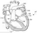 Fig. 01 - Prosthetic cardiovascular valves and methods for replacing native atrioventricular valves with same