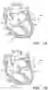 Fig. 02 - Prosthetic cardiovascular valves and methods for replacing native atrioventricular valves with same