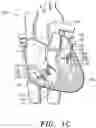 Fig. 03 - Prosthetic cardiovascular valves and methods for replacing native atrioventricular valves with same