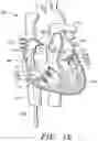 Fig. 28 - Prosthetic cardiovascular valves and methods for replacing native atrioventricular valves with same