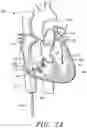 Fig. 33 - Prosthetic cardiovascular valves and methods for replacing native atrioventricular valves with same