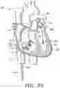 Fig. 34 - Prosthetic cardiovascular valves and methods for replacing native atrioventricular valves with same