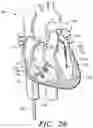 Fig. 35 - Prosthetic cardiovascular valves and methods for replacing native atrioventricular valves with same
