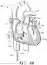 Fig. 37 - Prosthetic cardiovascular valves and methods for replacing native atrioventricular valves with same