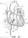Fig. 40 - Prosthetic cardiovascular valves and methods for replacing native atrioventricular valves with same