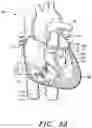 Fig. 41 - Prosthetic cardiovascular valves and methods for replacing native atrioventricular valves with same