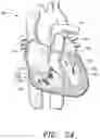 Fig. 43 - Prosthetic cardiovascular valves and methods for replacing native atrioventricular valves with same