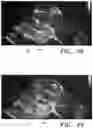 Fig. 48 - Prosthetic cardiovascular valves and methods for replacing native atrioventricular valves with same
