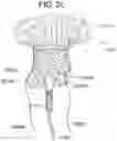 Fig. 05 - Prosthetic heart valve and systems and methods for delivering the same