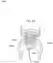 Fig. 33 - Prosthetic heart valve and systems and methods for delivering the same