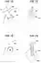 Fig. 07 - Methods and devices for preparing and implanting tissue scaffolds
