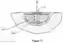 Fig. 17 - APPARATUS FOR ASPIRATING, IRRIGATING AND CLEANSING WOUNDS