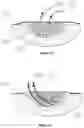 Fig. 22 - APPARATUS FOR ASPIRATING, IRRIGATING AND CLEANSING WOUNDS