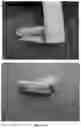 Fig. 04 - TISSUE EXPANSION METHOD