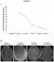 Fig. 13 - Imipridones for gliomas