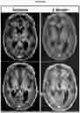 Fig. 19 - Imipridones for gliomas