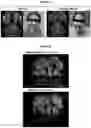 Fig. 20 - Imipridones for gliomas