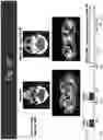 Fig. 11 - EZH2 INHIBITORS FOR TREATING LYMPHOMA