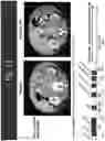 Fig. 12 - EZH2 INHIBITORS FOR TREATING LYMPHOMA