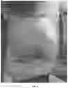 Fig. 05 - Applications of genetically engineered bacteria VNP20009-M in preparation of drugs for preventing and treating lung cancer