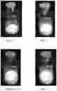 Fig. 03 - Pharmaceutical composition comprising plasminogen and uses thereof