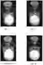 Fig. 04 - Pharmaceutical composition comprising plasminogen and uses thereof