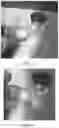 Fig. 06 - Pharmaceutical composition comprising plasminogen and uses thereof