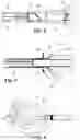 Fig. 04 - Sutureless anchoring device for heart pump