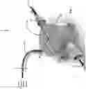 Fig. 02 - Blood pump system for causing persistent increase in the overall diameter of a target vessel