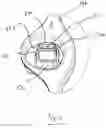 Fig. 07 - Fluid cassette with alignment latching having an improved tilt-tolerance as well as a blood treatment apparatus