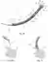 Fig. 14 - Endotracheal tube-inserting device