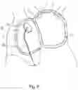Fig. 07 - Guide wire, medical device, and treatment method