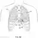 Fig. 06 - CARDIAC PACING