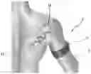 Fig. 01 - Device and method for the treatment of joint instability