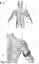 Fig. 03 - Device and method for the treatment of joint instability