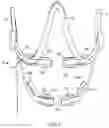 Fig. 03 - METHOD AND APPARATUS FOR TOOTH REGULATION WITH HEAVY FORCES