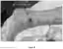 Fig. 09 - METHODS OF TREATING MELANOMA