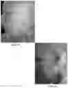 Fig. 35 - METHODS OF TREATING MELANOMA