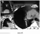 Fig. 49 - METHODS OF TREATING MELANOMA