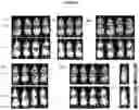 Fig. 44 - Recombinant adeno-associated virus capsids with enhanced human pancreatic tropism