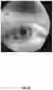 Fig. 03 - Determining eye openness with an eye tracking device