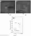 Fig. 06 - Predicting response to anti-vascular endothelial growth factor therapy with computer-extracted morphology and spatial arrangement features of leakage patterns on baseline fluorescein angiography in diabetic macular edema