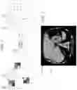 Fig. 06 - Knockout autoencoder for detecting anomalies in biomedical images
